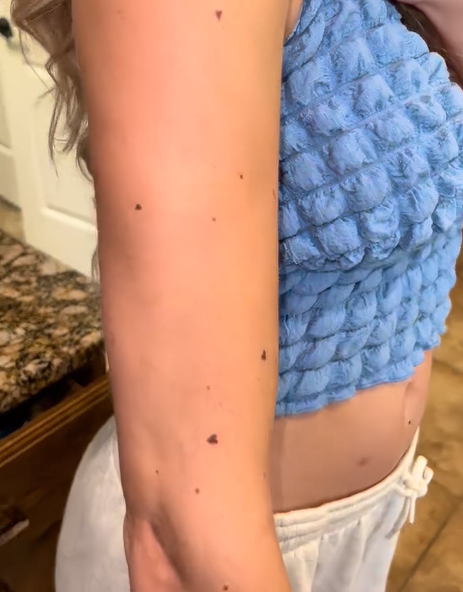 Tatouages Taches de Rousseur : Entre Esthétique Subtile et Précautions Dermatologiques